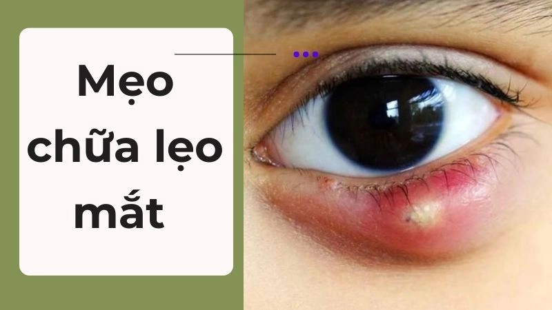 Lẹo mắt hình thành do đâu và dấu hiệu nhận biết