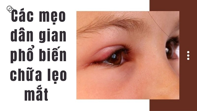 Các mẹo dân gian phổ biến chữa lẹo mắt tại nhà