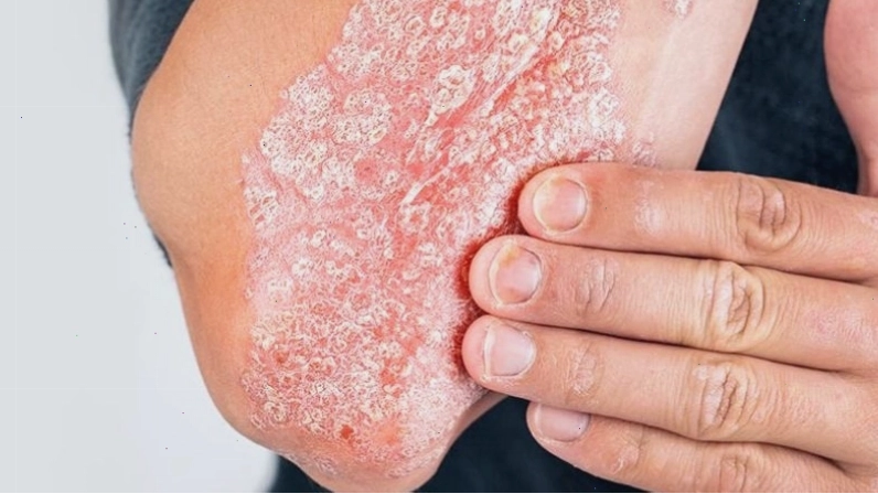 Bệnh vảy nến là một trong những yếu tố có thể liên quan đến nguyên nhân gây viêm lưỡi bản đồ