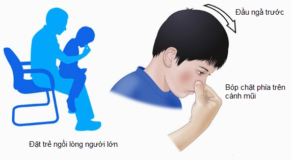 Bí quyết xử lý chảy máu cam tại nhà nhanh chóng và hiệu quả