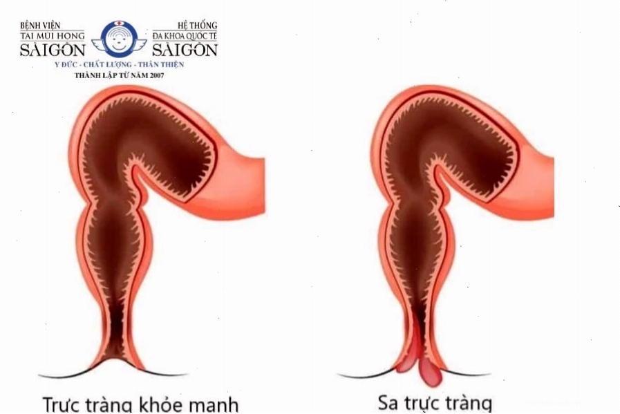 Biến chứng nguy hiểm của táo bón kéo dài