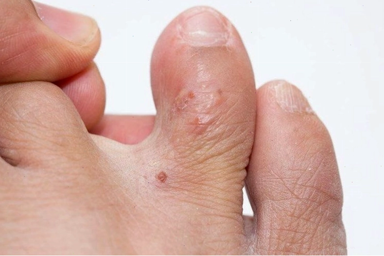 Biểu hiện của bệnh tổ đỉa là xuất hiện các mụn nước tại kẽ các ngón tay và chân