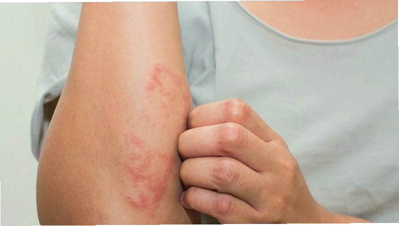 Biểu hiện viêm da dị ứng khi bị dị ứng thịt bò