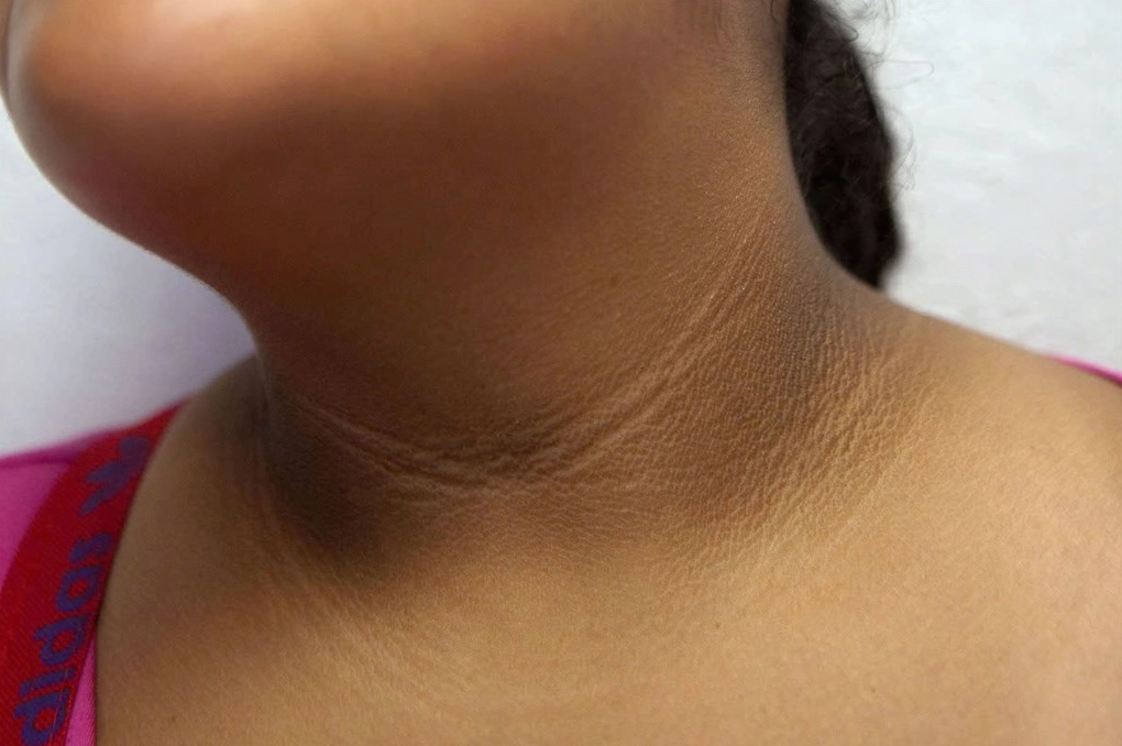 Cách chữa bệnh gai đen tại nhà và những lưu ý quan trọng