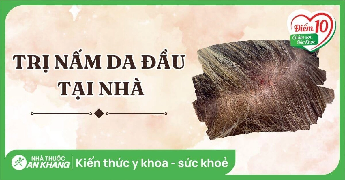 Cách trị nấm da đầu bằng dung dịch vệ sinh: Hiệu quả và lưu ý