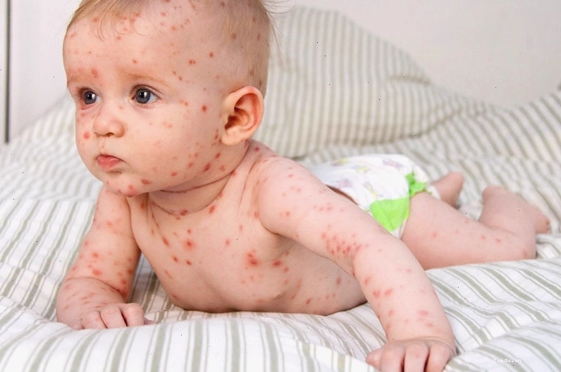 Da trẻ có thể xuất hiện nốt ban đỏ khi bị sốt virus