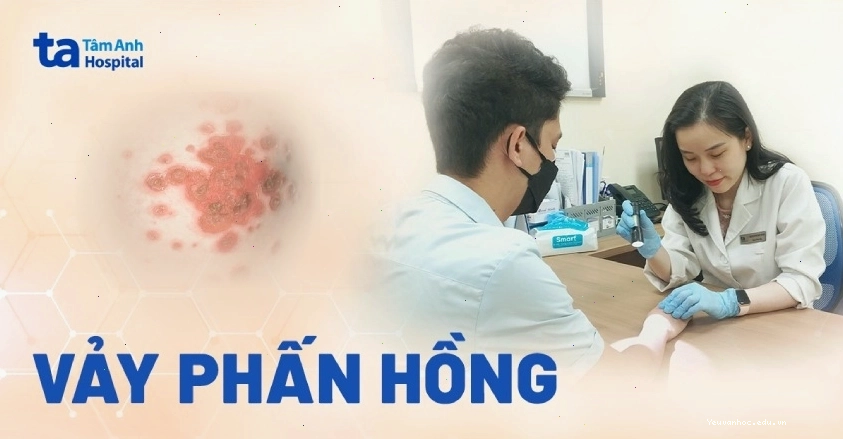 Hình ảnh minh họa tổn thương da do vảy phấn hồng