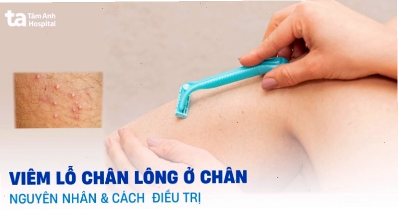 Hình ảnh viêm lỗ chân lông ở chân với các nốt sần đỏ li ti