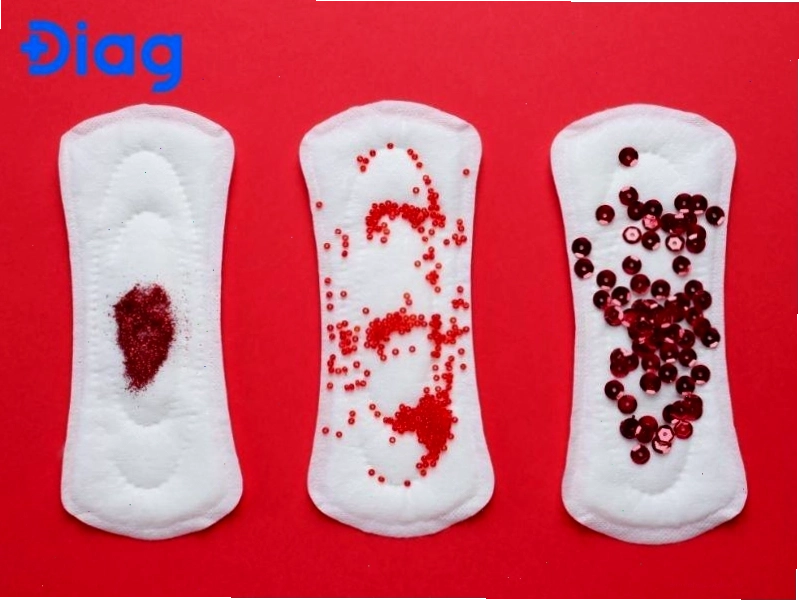 Minh họa tử cung co bóp kém dẫn đến kinh nguyệt vón cục