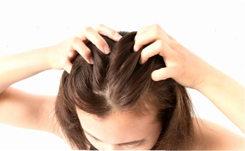 Nấm da đầu ảnh hưởng lớn đến thẩm mỹ và sự tự tin