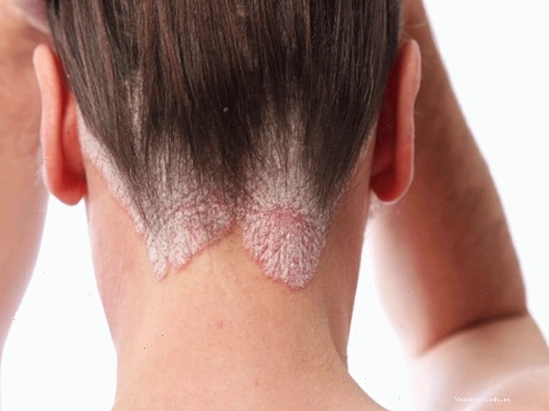 Người bệnh nấm da đầu bị cảm giác ngứa vô cùng bứt rứt