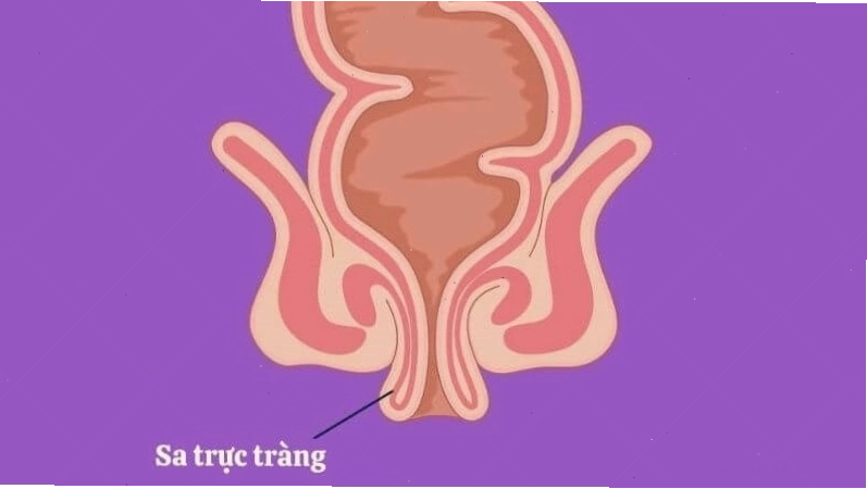 Sa trực tràng là tình trạng một phần hoặc toàn bộ thành trực tràng bị bị lộn ngược ra ngoài hậu môn