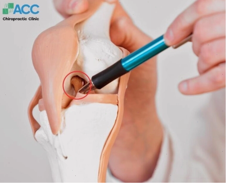 Tìm hiểu về các loại chấn thương dây chằng và cách phục hồi
