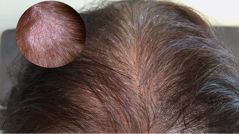 Tìm hiểu về việc sử dụng dung dịch vệ sinh để trị nấm da đầu