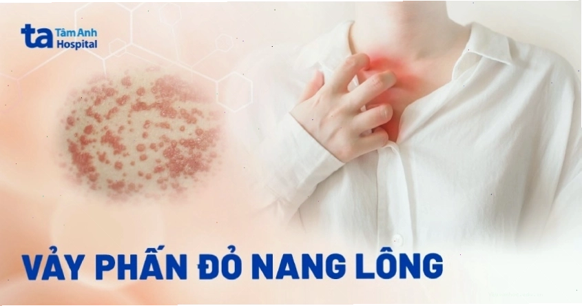 Vảy phấn đỏ nang lông