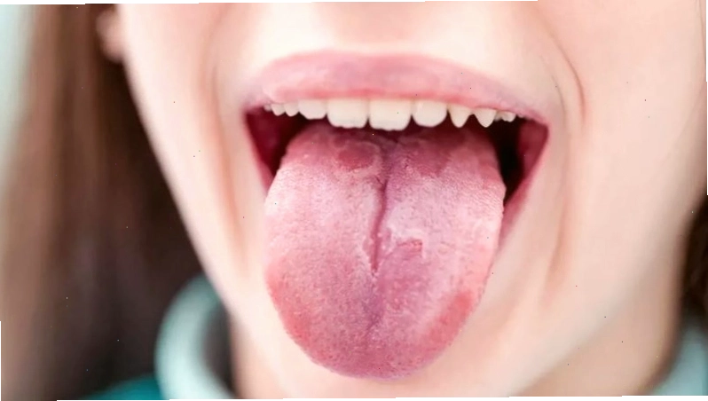Viêm lưỡi bản đồ đặc trưng bởi sự biến mất của các nhú lưỡi thành từng mảng màu đỏ