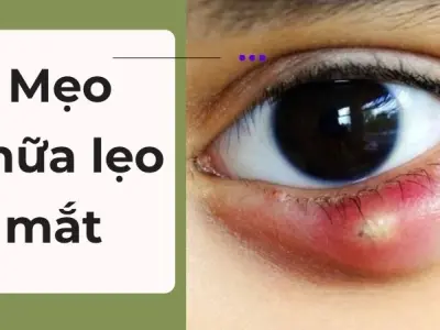 Mẹo chữa lẹo mắt được nhiều người truyền tai nhau