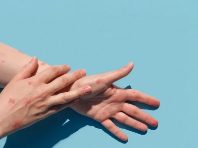 Bí quyết trị vảy phấn hồng tại nhà hiệu quả