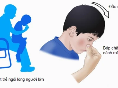 Bí quyết xử lý chảy máu cam tại nhà nhanh chóng và hiệu quả
