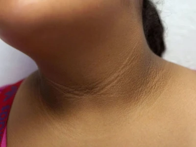 Cách chữa bệnh gai đen tại nhà và những lưu ý quan trọng
