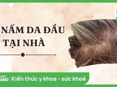 Cách trị nấm da đầu bằng dung dịch vệ sinh: Hiệu quả và lưu ý