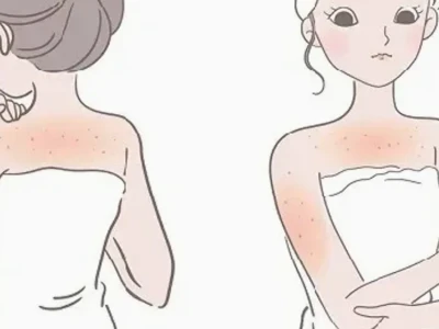 Cách trị viêm lỗ chân lông ở chân tại nhà hiệu quả